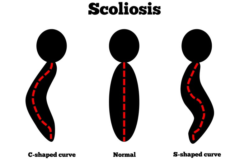Federal Way, Washington scoliosis treatment